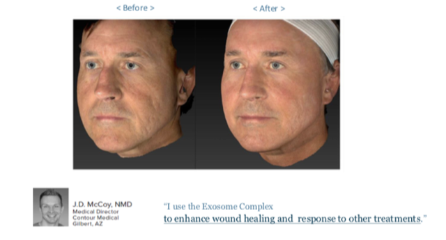 Exosomes before and after