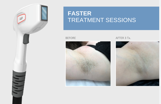 Laser air removal